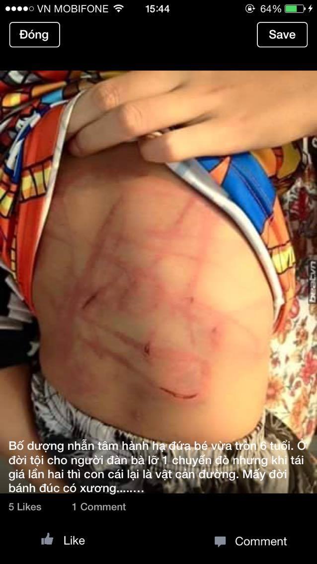 
Hình ảnh tấm lưng còi cọc của em bé 6 tuổi bị đánh đến toé máu
