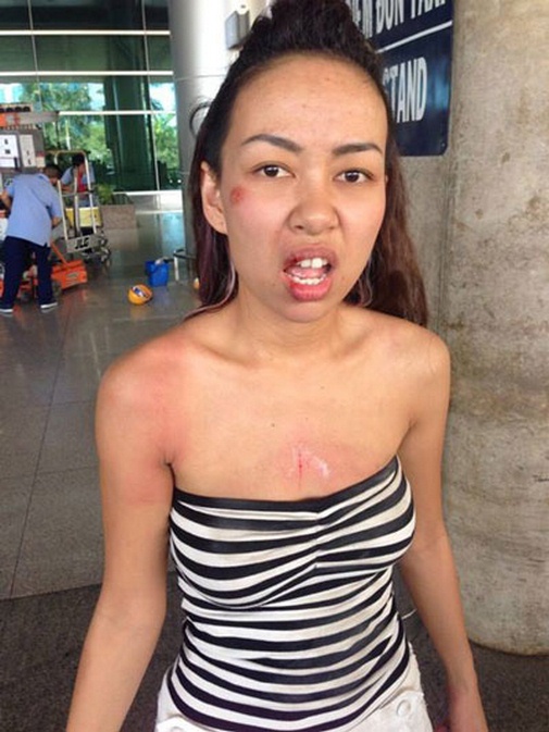 
Khuôn mặt trầy xước của Thảo Trang sau khi bị cướp giật.
