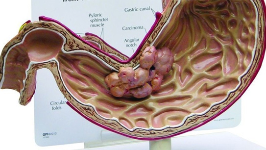 
Hình ảnh về ung thư dạ dày 

