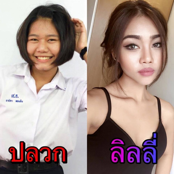 Những hình ảnh trước và sau PTTM của Naika.