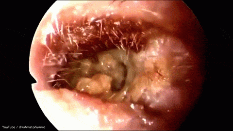 
Cận cảnh những mảng ráy tai trong lỗ tai bệnh nhân.
