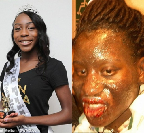 
Trước và sau khi Marian Adejokun bị lột da.

