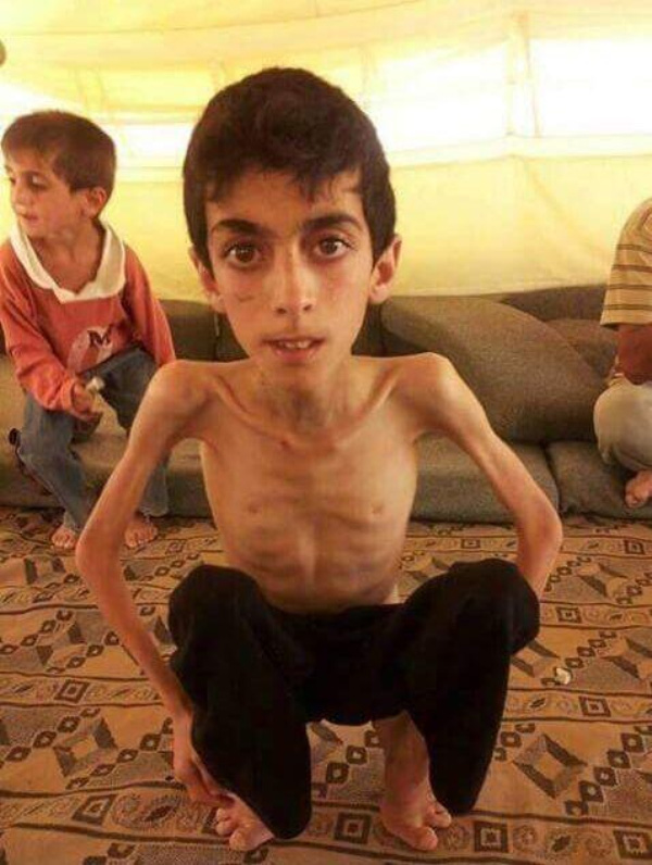 
Một cậu bé Syria bị suy dinh dưỡng nặng.
