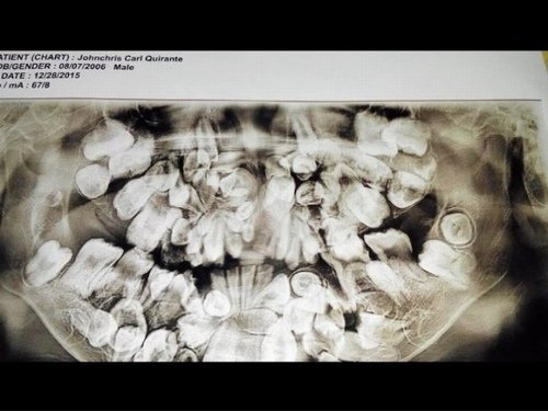 
Phim chụp X-quang vòm miệng chi chít răng của John
