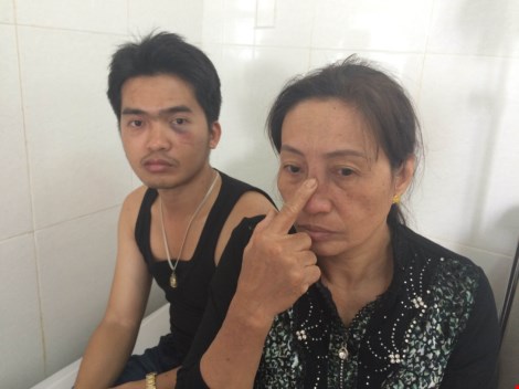 Bà Trần Thị Thảo cho biết, bị nhóm côn đồ dùng mũ bảo hiểm đánh vào mặt chấn thương 