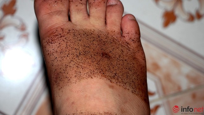 
Chỗ sạch trên bàn chân là do quai dép che đi.

