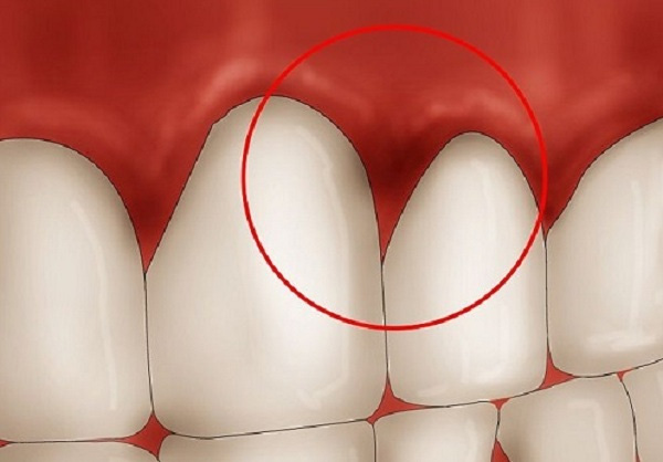 
Các chất tẩy trắng chứa trong kem đánh răng có thể gây viêm nướu.
