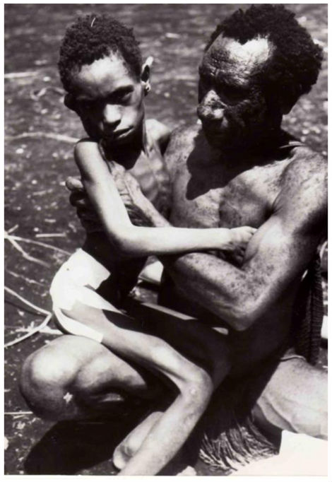 
Bé gái tộc Fore (trái) thuộc đảo Papua New Guinea ở thời kỳ cuối của bệnh Kuru.
