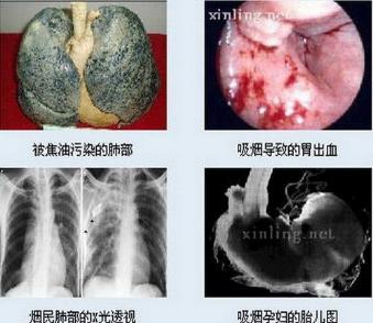 
4 tác hại khủng khiếp của việc hút thuốc lá.

