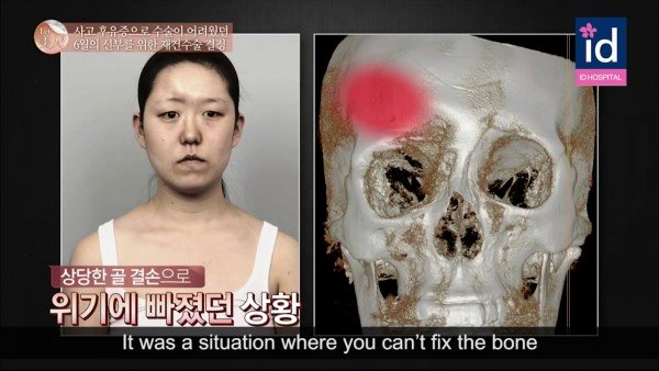 Do bị tai nạn từ quá nhỏ, các bác sĩ thẩm mỹ cho biết, họ không thể chỉnh sửa phần xương của cô