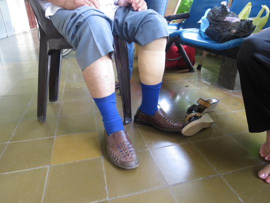 
Đôi chân một bệnh nhân với bên chân trái là chân giả đã được hoàn thiện
