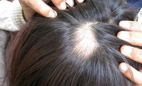 
Giật tóc nhiều dẫn tới hói đầu.
