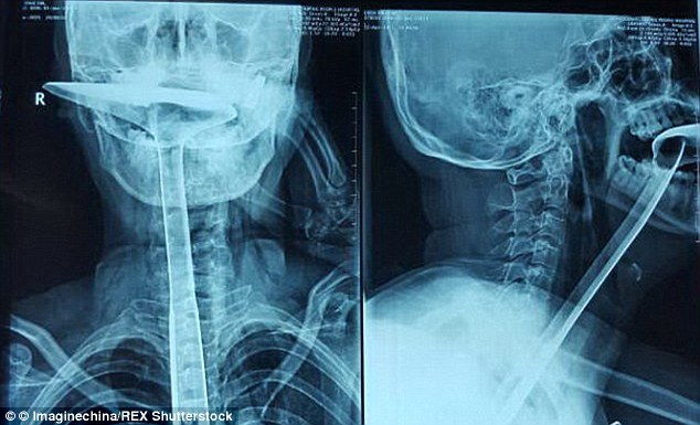 
Hình ảnh chụp X-quang chiếc thìa mắc trong cổ họng người phụ nữ ở Trung Quốc
