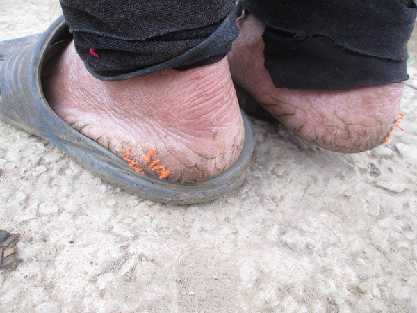 
Bức ảnh chụp đôi bàn chân nứt nẻ vì trời lạnh của một bà cụ khiến ngươi xem thực sự bị ám ảnh (Nguồn ảnh: Facebook C.S.C)
