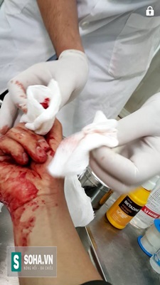
Vết thương trên tay nhà báo Đỗ Doãn Hoàng do bị 3 đối tượng lạ mặt tấn công.
