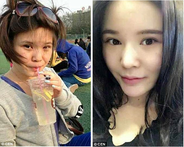 
Xiao Xiao trước (trái) và sau (phải) khi phẫu thuật hút mỡ.
