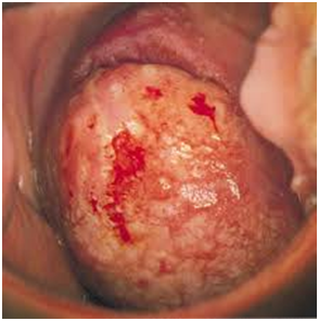 
Một số chủng HPV có thể gây nên bệnh ung thư cổ tử cung cho phụ nữ (Ảnh minh họa)
