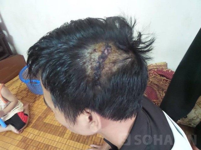 Vết thương trên đầu của anh Thùy (ảnh chụp hôm 30/7).