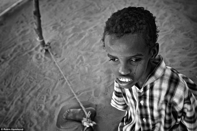 
Cậu bé Ahmed Adan Ahmed, 13 tuổi, bị chính mẹ mình trói bên cạnh lều của người tị nạn tại Somalia. Mẹ cậu không biết làm cách nào để đối phó với căn bệnh của con.

