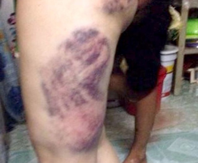 Vết bầm tím trên chân chị Thu sau khi bị đánh.