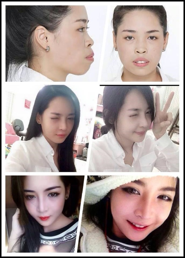 Hình ảnh trước và sau khi PTTM của Thanh Quỳnh đã trở thành đề tài rất được quan tâm của mạng xã hội Việt