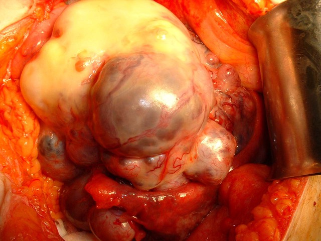 Hình ảnh đáng sợ của ung thư buồng trứng (Ảnh minh họa)