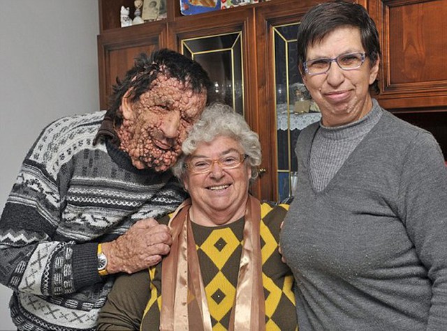 Ông Vinicio Riva, 53 tuổi, người Ý không may mắc phải căn bệnh u xơ thần kinh khiến toàn thân mọc đầy những cục thịt xù xì.