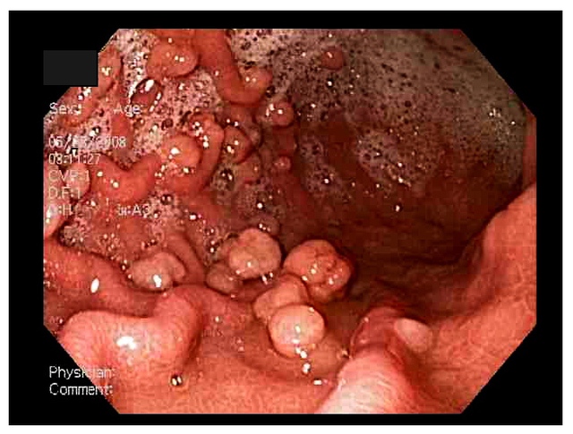 Hình ảnh polyp dạ dày thông qua nội soi dạ dày.