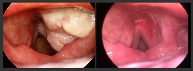 Thanh quản bị ung thư và thanh quản bình thường