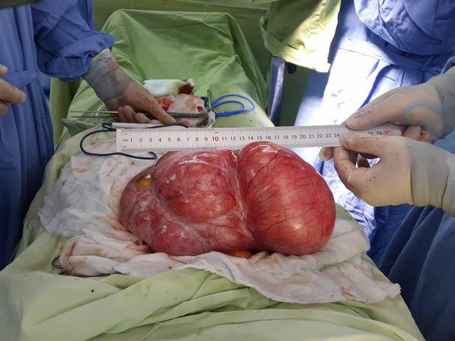 
Khối u nặng 4,3kg được lấy ra khỏi bụng bệnh nhân
