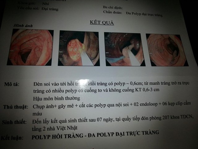 
Hình ảnh bệnh nhân Ph. được bác sĩ cắt polyp tại BV Bạch Mai.
