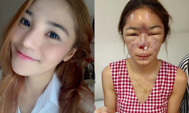 Gương mặt Taiwanrat biến dạng sau khi phẫu thuật thẩm mỹ (phải).