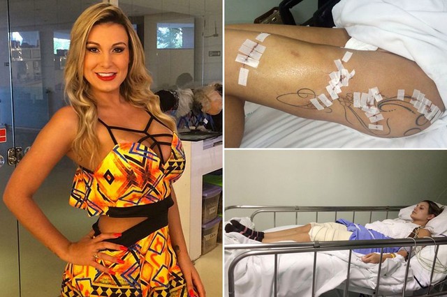 Andressa Urach may mắn thoát chết sau khi bị viêm nhiễm các bộ phận từng phẫu thuật thẩm mỹ.