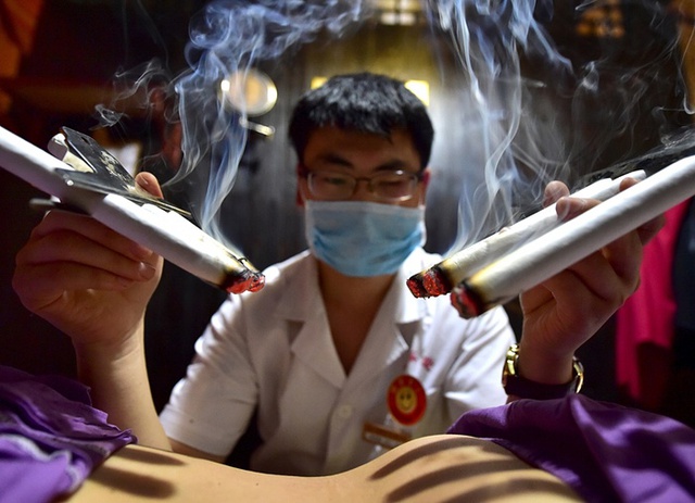 Bệnh nhân được điều trị bằng liệu pháp đốt ngải truyền thống ở thành phố Nghĩa Ô, Trung Quốc.
