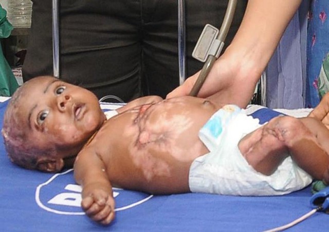 Năm 2013, Daily Mail đưa tin cơ thể cậu bé ba tháng tuổi ở Ấn Độ tự nhiên bốc cháy bất thường 4 lần. Theo nghiên cứu, chính mồ hôi tiết ra từ lỗ chân lông trên cơ thể cậu bé là nguyên nhân gây ra những “đốm lửa tự nhiên”.