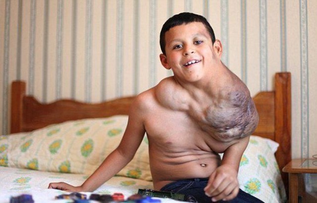 Cậu bé Jose Antonio Ramirer Serrano, 12 tuổi đến từ Mexico có một khối u khổng lồ trông như một quả bóng ở bả vai. Giữa tháng 11.2014, cậu bé đã được thực hiện phẫu thuật thành công tại Mỹ.