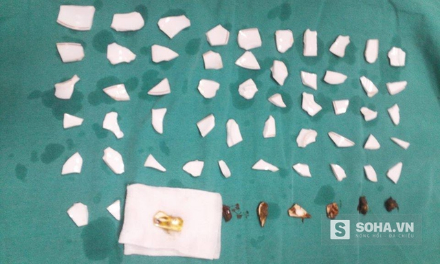 59 mảnh vỡ được bác sỹ lấy ra từ trong bụng bệnh nhân