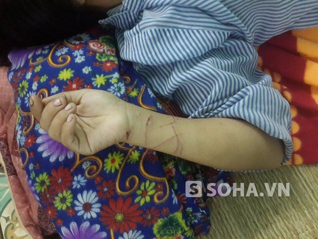 Các vết thương trên tay chị Dương Thị H. trong lúc giằng co, chống đỡ chồng