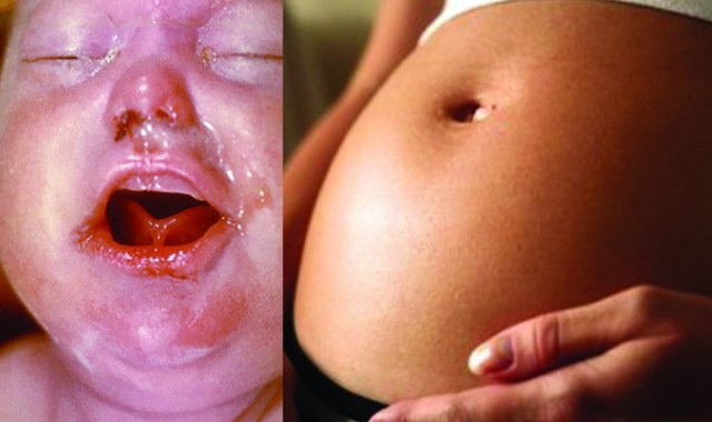 Trẻ lây nhiễm giang mai khi mẹ mang thai