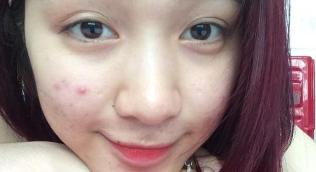 
Là ca sĩ nhưng không phải hình ảnh của Hòa Minzy lúc nào cũng xinh xắn, đây là một bức hình do chính tay cô đăng lên trang Instagram, gương mặt đầy mụn và làn da không khỏe mạnh.
