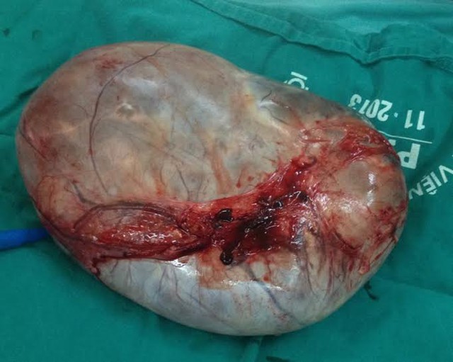 
Khối u buồng trứng khủng lấy ra từ bụng bệnh nhân (Ảnh do bác sĩ cung cấp)
