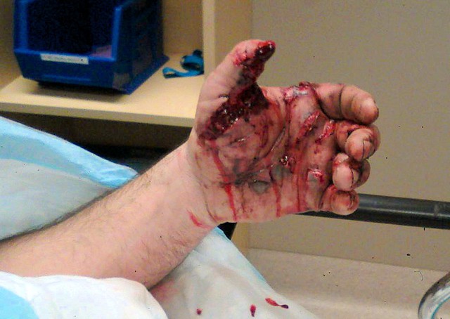 
Bàn tay bị thương do bắn súng khi trong nòng vẫn kẹt đạn
