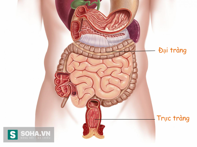 Ung thư đại trực tràng - hậu quả từ thói quen ăn uống - Ảnh 1.