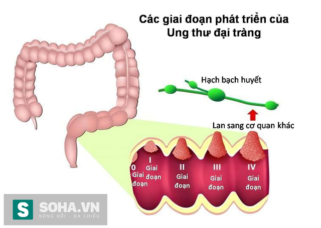 Ung thư đại trực tràng: Có triệu chứng đi khám ngay, phát hiện sớm dễ chữa khỏi - Ảnh 3.