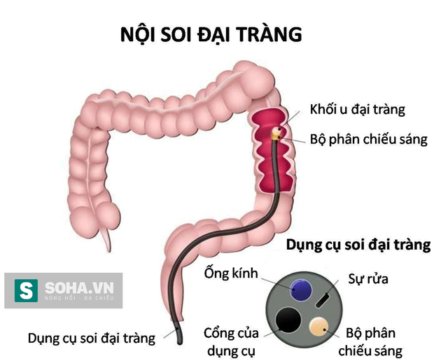 Ung thư đại trực tràng: Có triệu chứng đi khám ngay, phát hiện sớm dễ chữa khỏi - Ảnh 2.