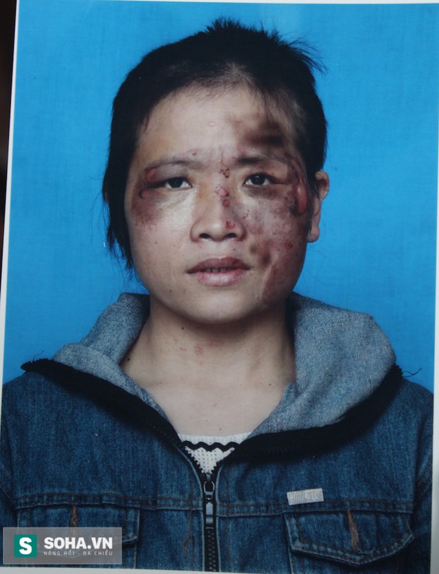 Hình ảnh các vết thương của chị Hồng tố bị chồng đánh sau khi được sơ cứu tại trạm y tế xã.