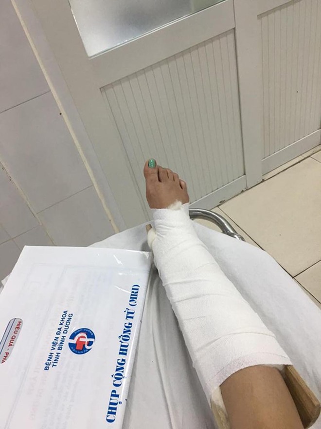 Hình ảnh chân băng bó sau khi bị tai nạn của Diệp Lâm Anh.