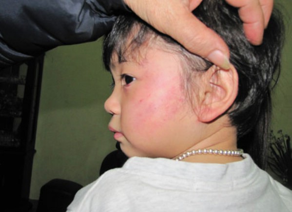 Nạn bạo hành trẻ em ở trường mầm non đang là nỗi lo của nhiều phụ huynh hiện nay. (ảnh Khánh Linh 2 tuổi  bị cô giáo đánh thâm tím mặt).