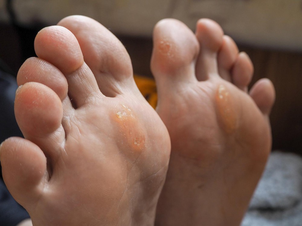 Nếu bỗng dưng thấy bàn chân có 5 sự thay đổi này, coi chừng cơ thể đang mắc trọng bệnh và cần được giải cứu - Ảnh 3.