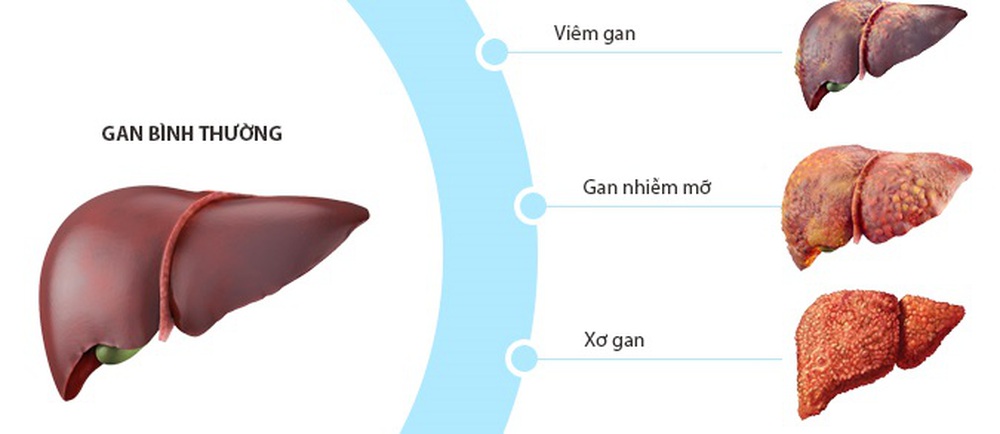 Gan nhiễm mỡ: Nhận biết dấu hiệu, nguyên nhân và điều trị sớm để ngừa xơ gan - Ảnh 5.